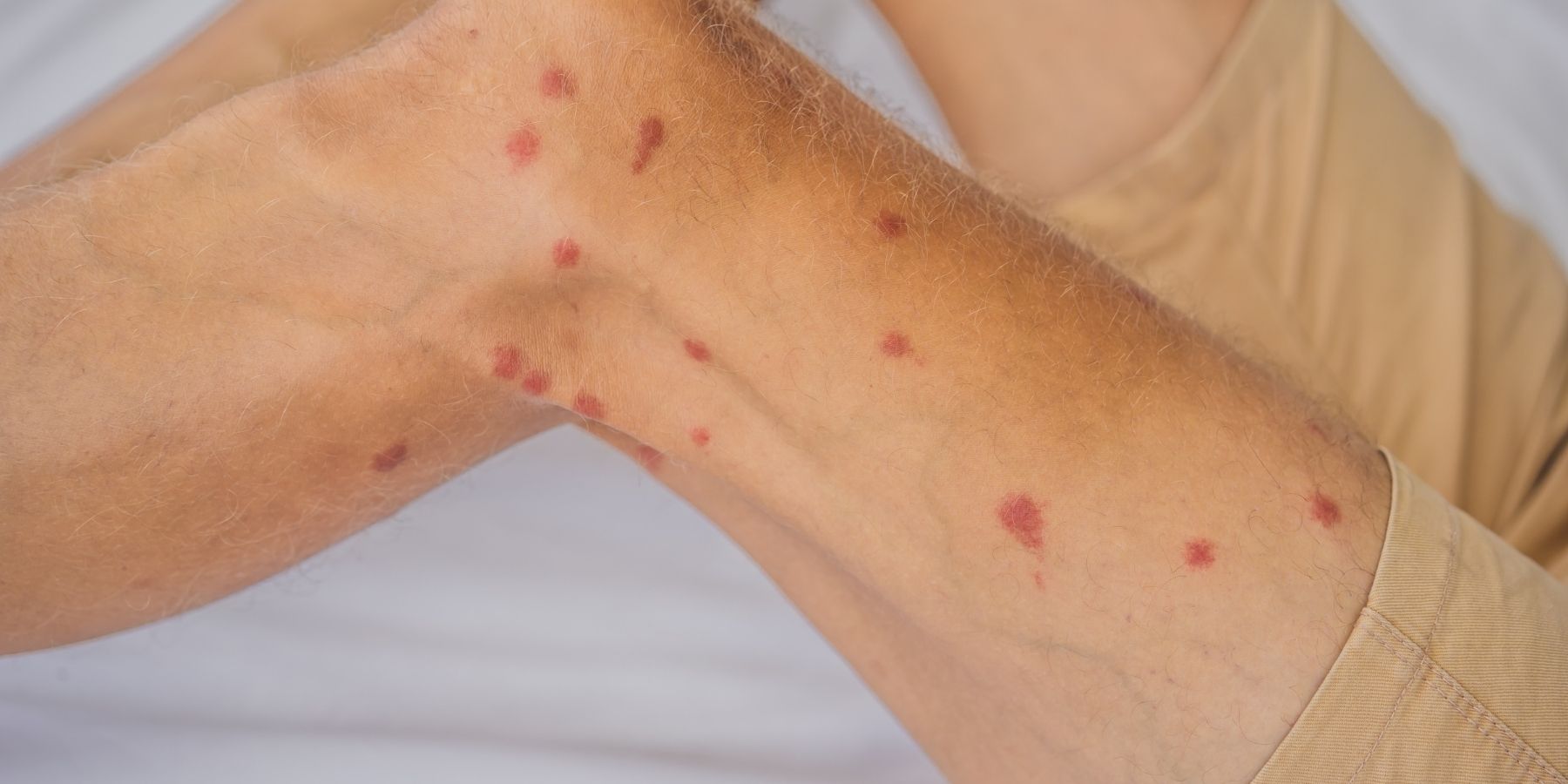 Do Mosquito Bites Heal Faster Than Bed Bug Bites?